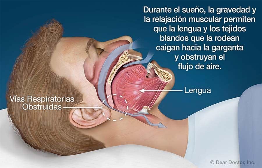 Adiós a la apnea del sueño con la operación de lengua