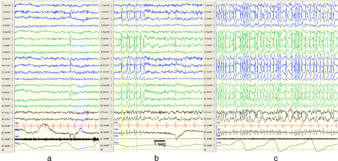 Alerta: Epilepsia con punta-onda continua en sueño lento