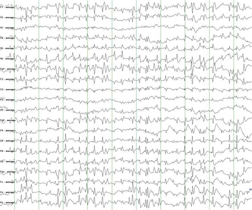 Alerta médica: Epilepsia de punta onda continua durante el sueño