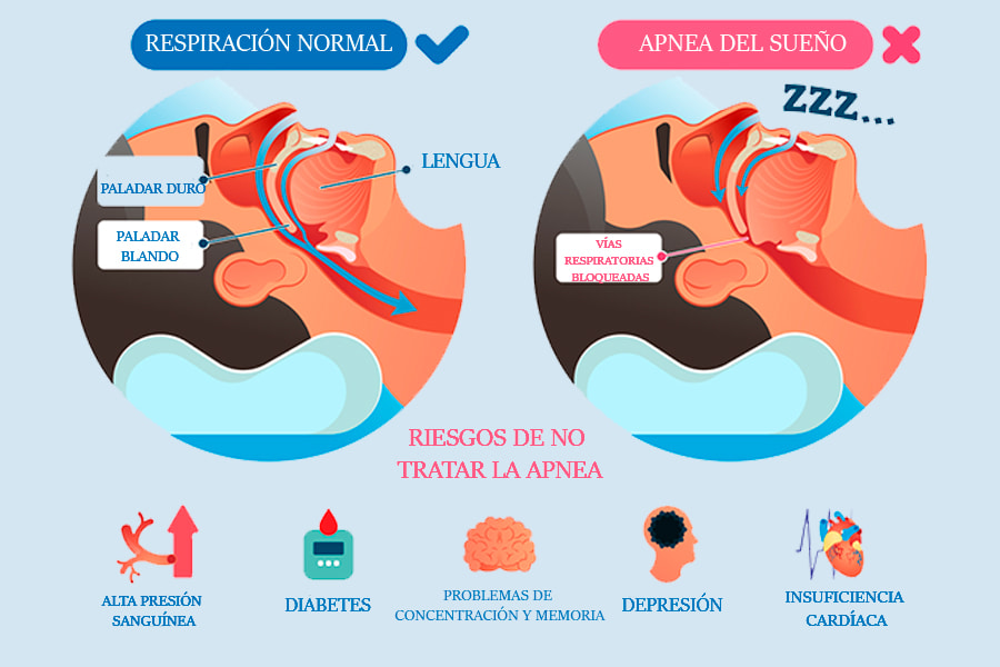 Apnea del sueño: causas y síntomas