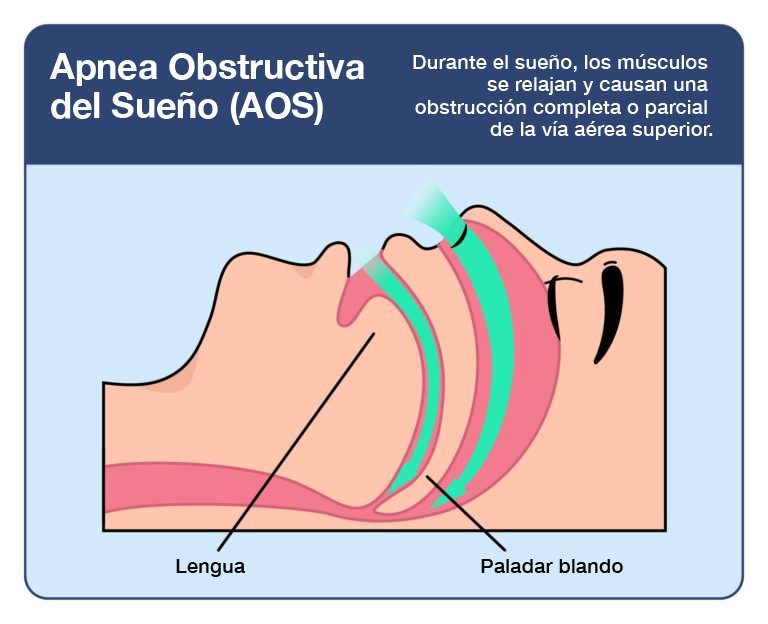 Apnea del sueño en México: ¿Cuántas muertes se registran?