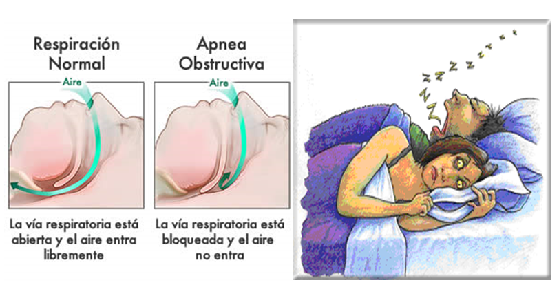 Apnea del sueño en obesos: ¿Por qué ocurre?