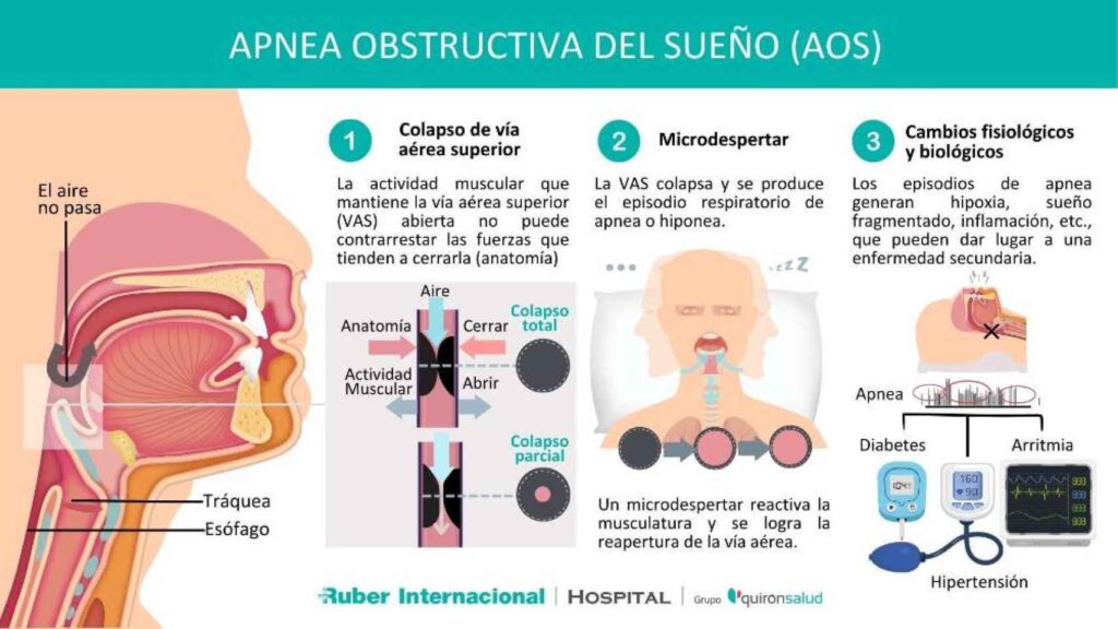 Atnea del sueño: riesgo de hipoxia cerebral irreversible