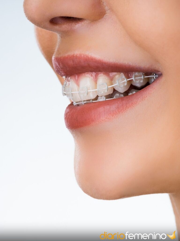 ¿Brackets cayendo en sueños? Descubre su significado aquí