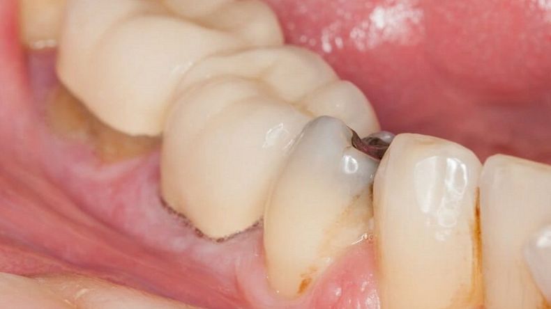 Cambia tus dientes podridos por nuevos sueños