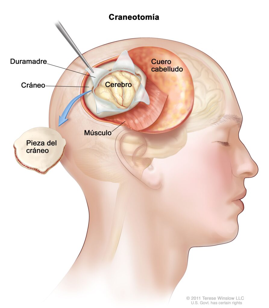 ¿Cómo afectan las fases del sueño si tienes un tumor cerebral?