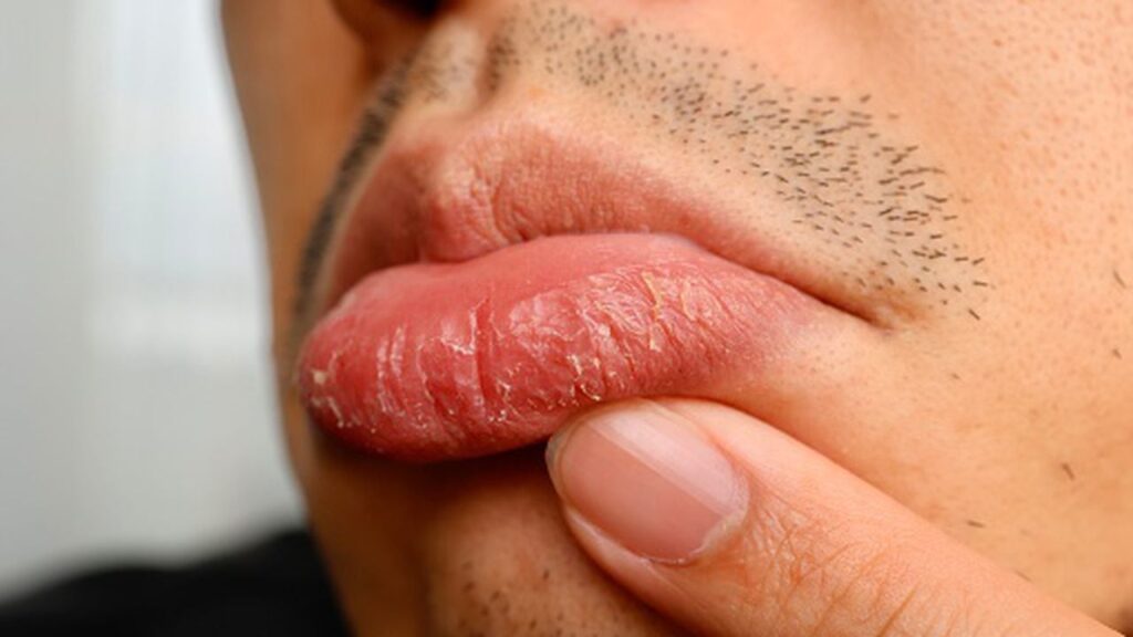 Consecuencias de comer en exceso: dolor de cabeza y labios secos