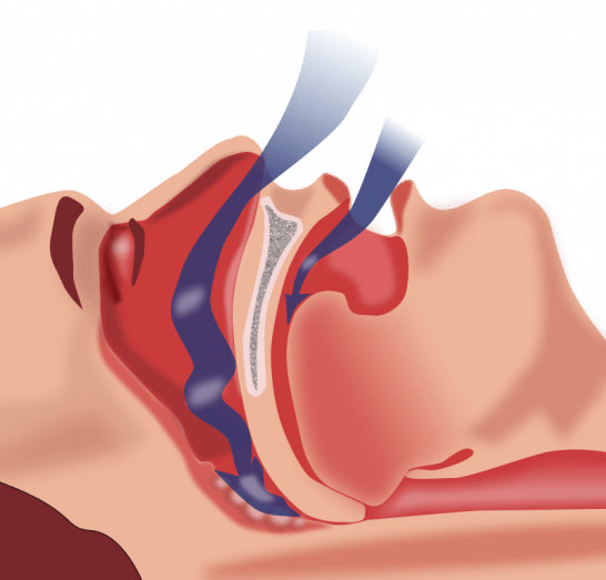 Controla la EPOC en pacientes con apnea del sueño con oximetría