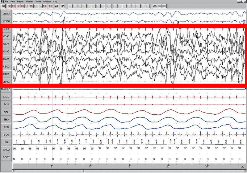 Descubre el EEG con privación de sueño: análisis de ondas cerebrales