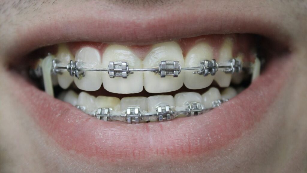 Descubre el significado de soñar con caída de brackets