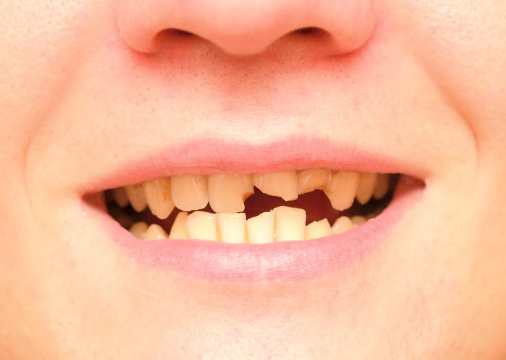 Descubre el significado de soñar con dientes caídos