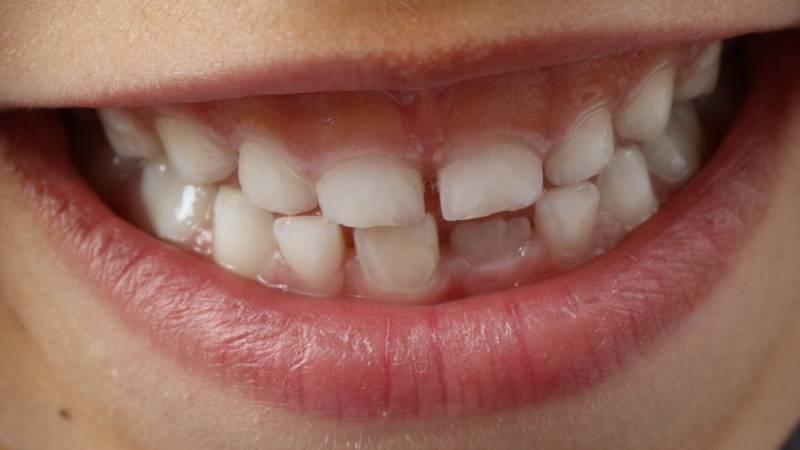 Descubre el significado de soñar con dientes que caen