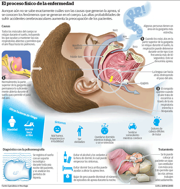 Descubre las causas del síndrome de apnea del sueño en detalle