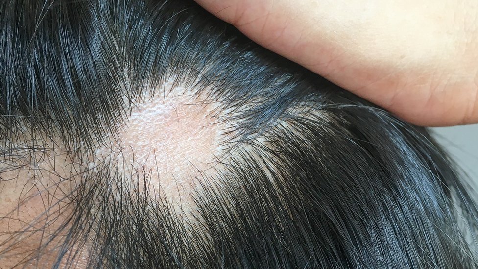 Descubre las causas del sueño excesivo y la pérdida de cabello