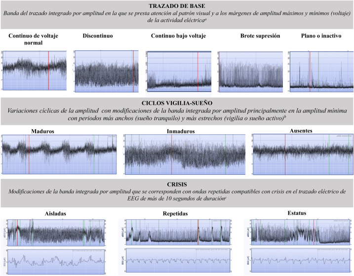Descubre todo sobre el patrón EEG de amplitud baja y frecuencia mixta