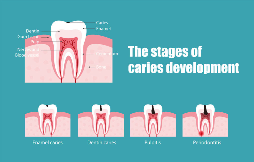 Dolor de diente por caries y sueño interrumpido: soluciones efectivas