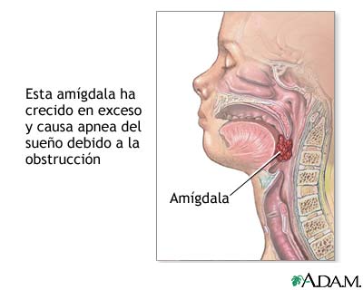 Dolor de garganta por apnea del sueño: Cómo aliviarlo