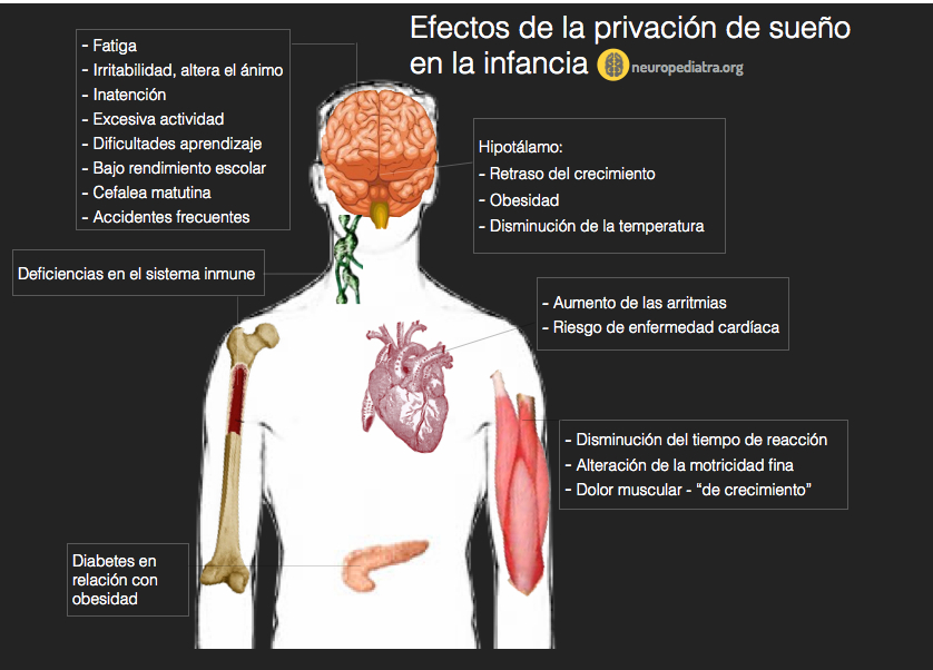 Enfermedad del sueño: infección en el sistema nervioso