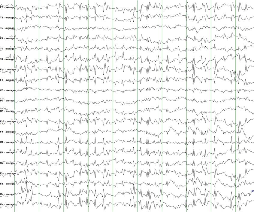 Epilepsia con Puntas-Ondas: Trastorno del Sueño