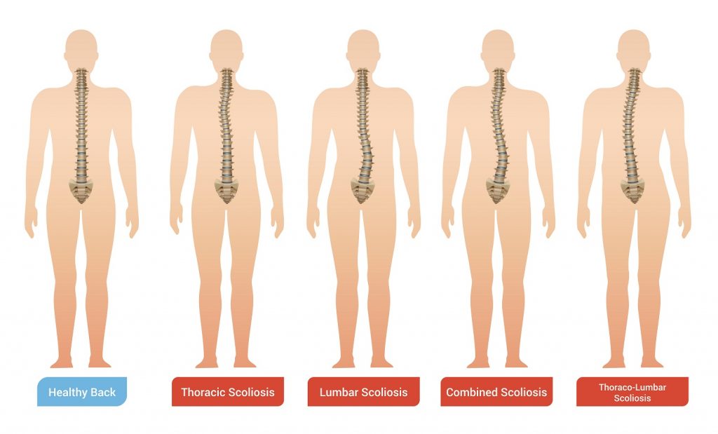 Escoliosis y apnea del sueño: la conexión invisible