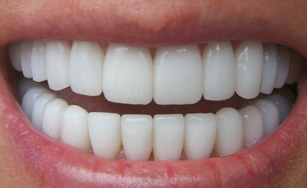 Fundas dentales vs. dientes: ¿Son lo mismo?