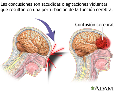 Golpe en la cabeza: síntomas de dolor, mareo y confusión