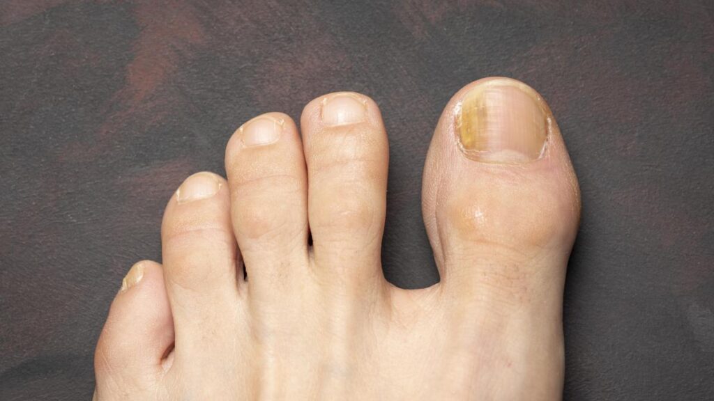 Hongos en las uñas de los pies: ¿Qué significa soñar con ellos?