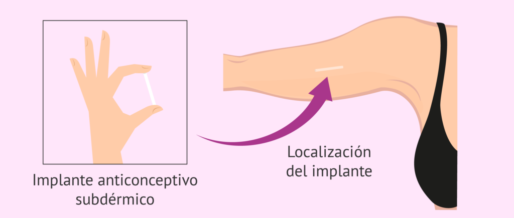 Implanon: ¿Acidez, hinchazón y sueños normales? Descúbrelo aquí