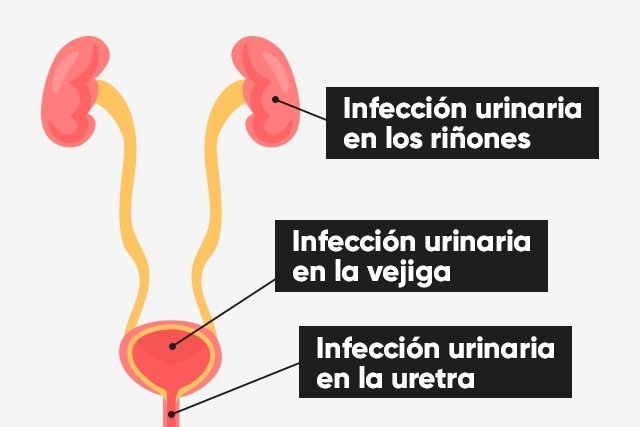 Infección urinaria y sueño: ¿Existe una conexión?