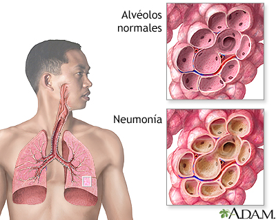 La verdad detrás de la neumonía y el sueño profundo