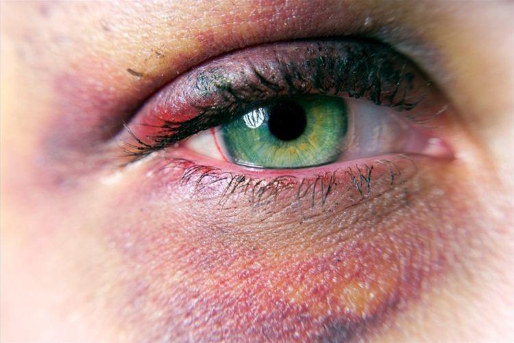 Ojo herido o cerrado: posibles causas y tratamientos