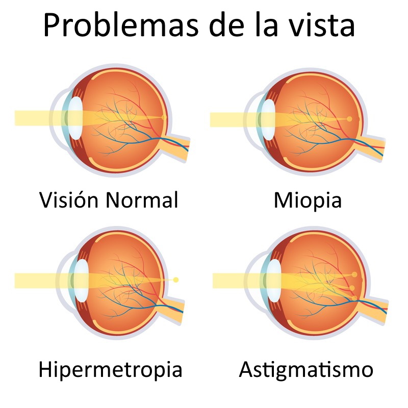 Operación de miopía y astigmatismo: ¿Es normal tener sueño?