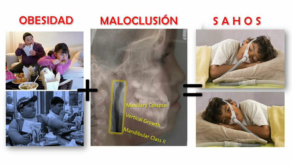 Ortodoncista: clave en el tratamiento del síndrome de apnea del sueño