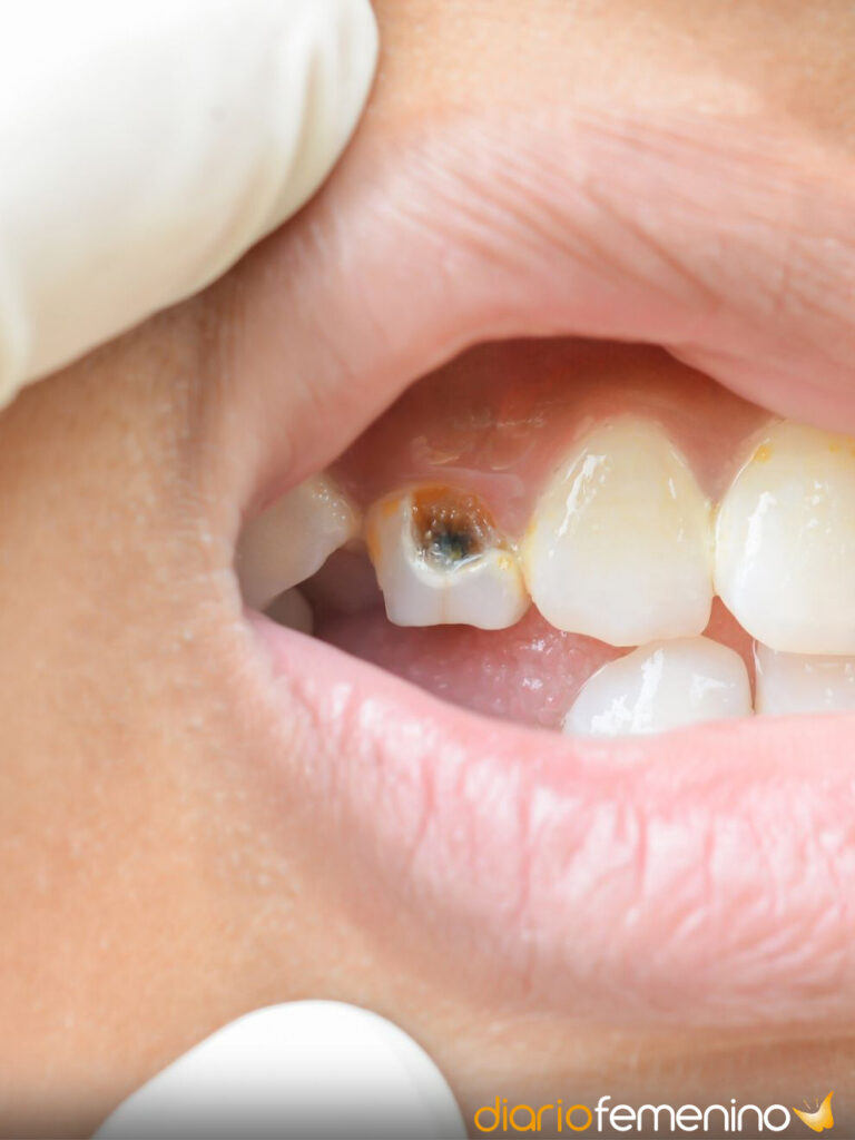 ¿Pesadilla dental? Descubre por qué sueñas con dientes podridos