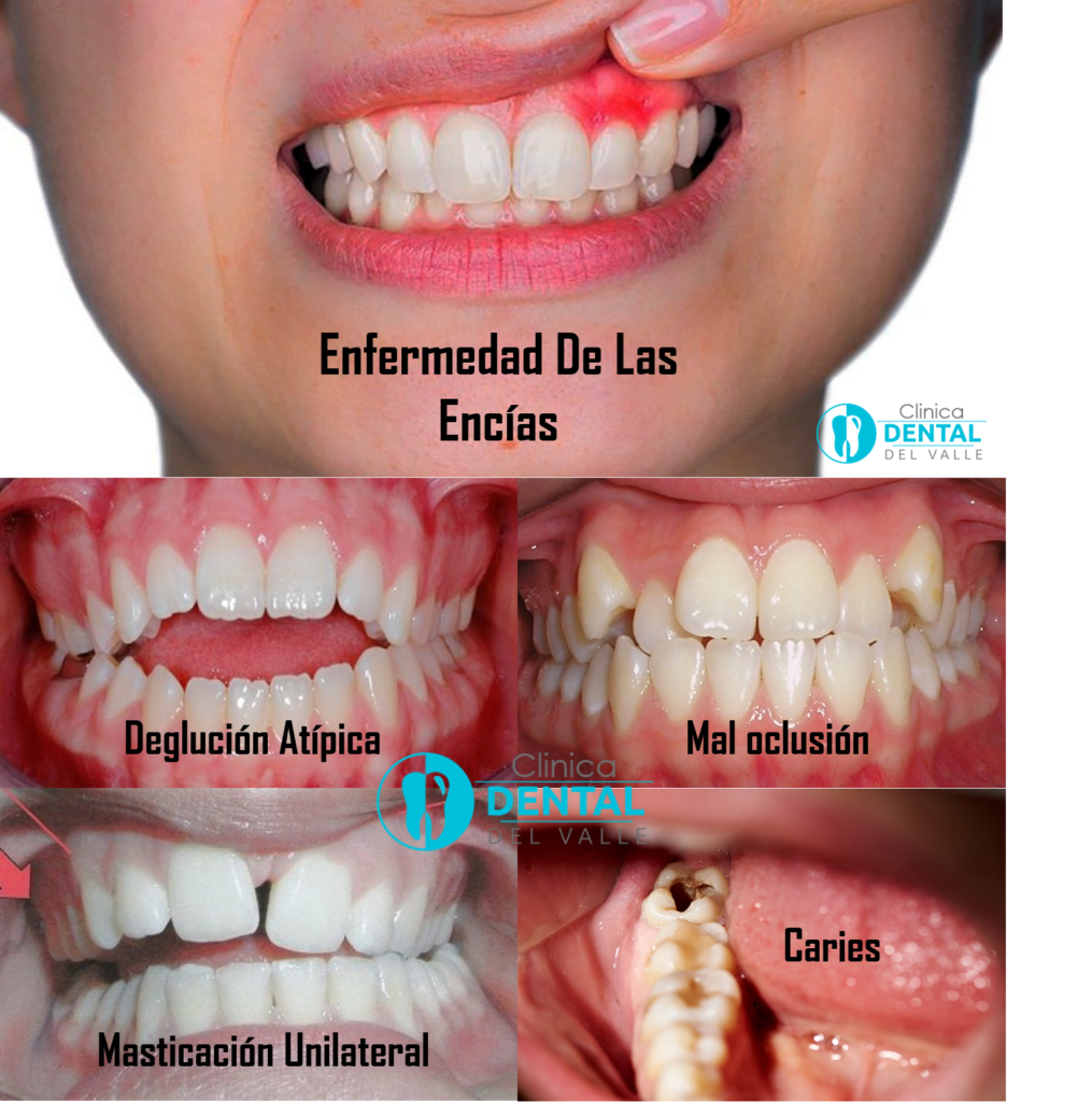 ¿Pesadilla o realidad? Caída de dientes postizos superiores