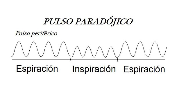 Pulso Paradojico en EPOC y Apnea del Sueño: Una Amenaza Silenciosa