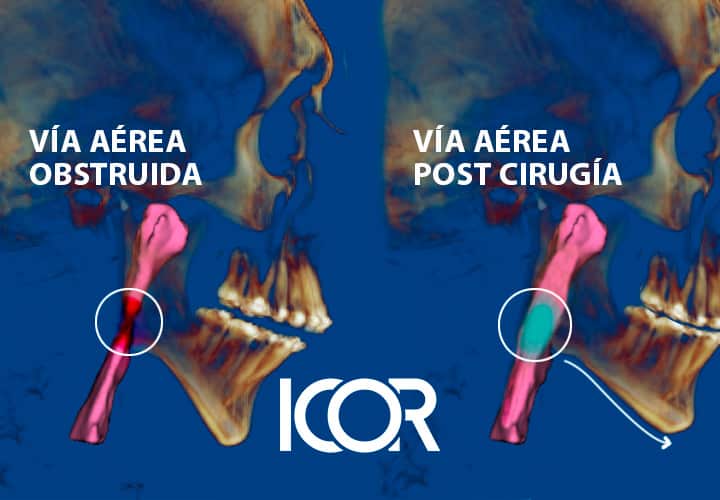 Recuperación tras cirugía del sueño: ¿Qué esperar?