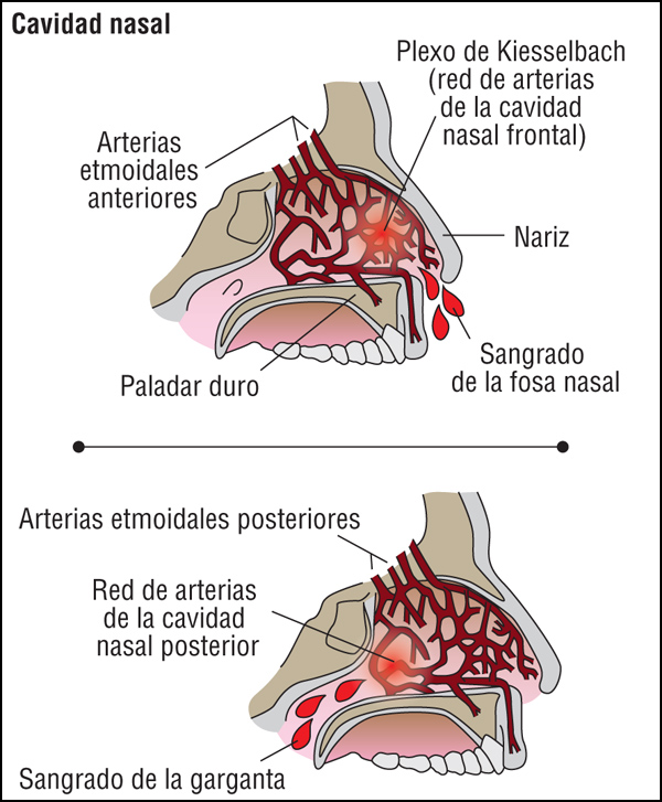 ¿Sangrado nasal y somnolencia? Descubre las posibles causas