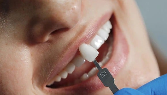 ¿Sueñas con perder tus dientes? Descubre su significado aquí