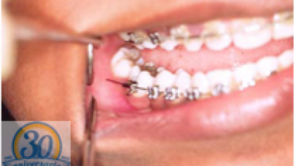 Sueño incómodo: caída de dientes y brackets con saliva