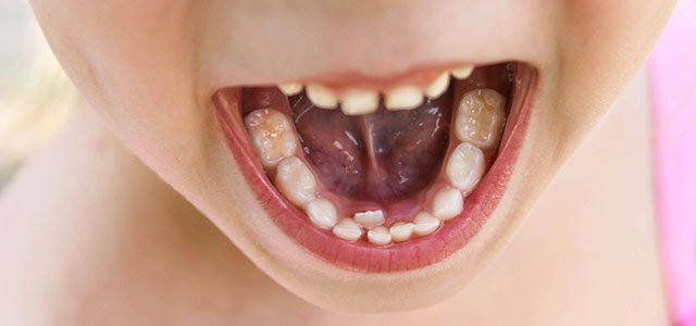 Sueño inquietante: ¿Por qué a mi hija le crecen los dientes detrás?