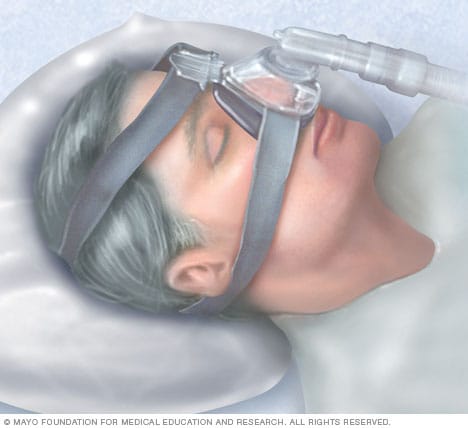 Tratamiento eficaz para la apnea del sueño: sigue nuestro protocolo